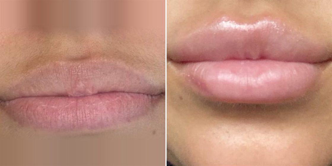 Antes e depois — Preenchimento Labial