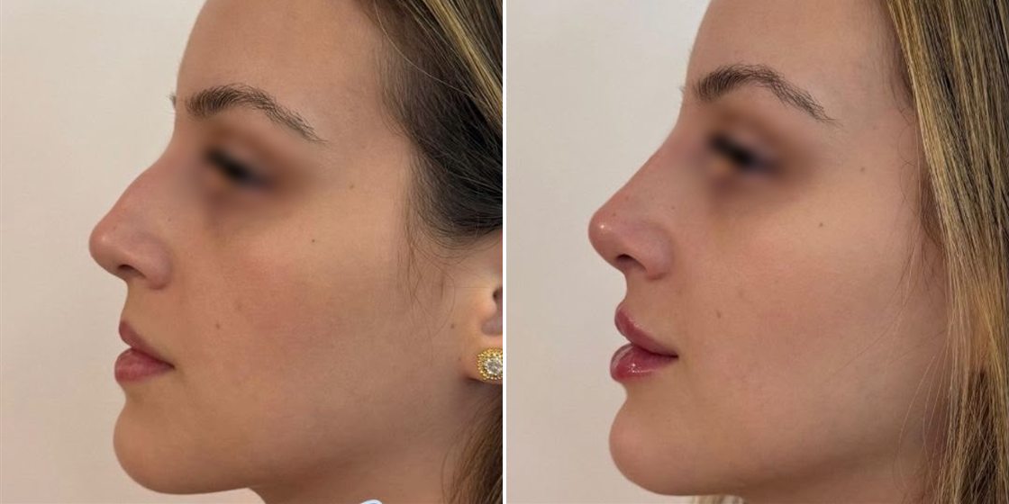 Antes e depois — Perfiloplastia