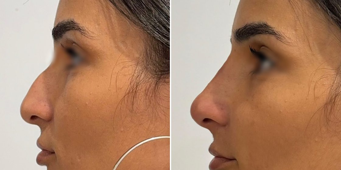 Antes e depois — Rinomodelação