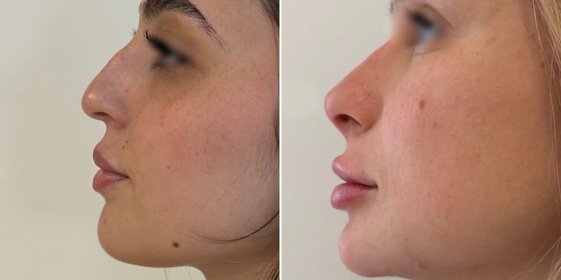 Antes e depois — Rinomodelação